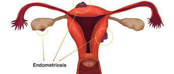 Can Endometriosis Get Worse with Age and best Endometriosis Treatment in Delhi?
