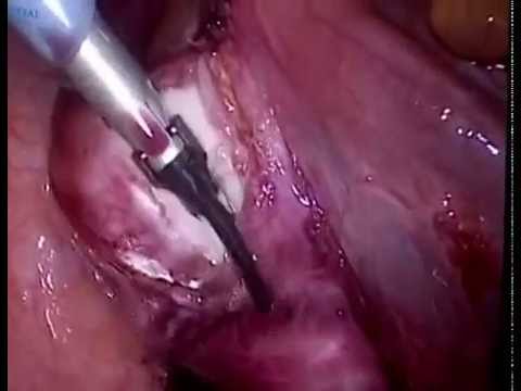 Laparoscopic Broad Ligament Fibroid