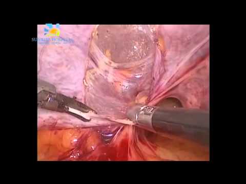 Cervical fibroid vasopressin, Surgery done by Dr Nikita Trehan in Sunrise Hospital New Delhi