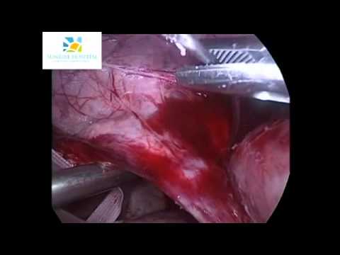 LAPAROSCOPIC ENCERCLAGE IN A PREGNANT PATIENT BY DR HAFEEZ RAHMAN