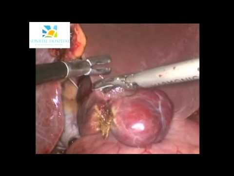 Laparoscopic Liver Mass Removal at Sunrise Hospital Delhi