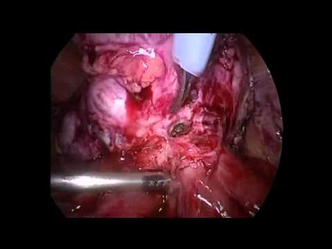 RARE CASE OF SQ CELL CARCINOMA IN DERMOID CYST MATURE TERATOMA OF OVARY WITH ILEO dermoid fistula