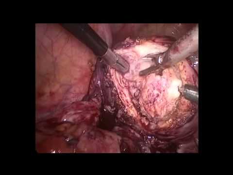 Resection of rectovaginal endometriosis done by Dr Nikita Trehan at Sunrise Hospital, New Delhi