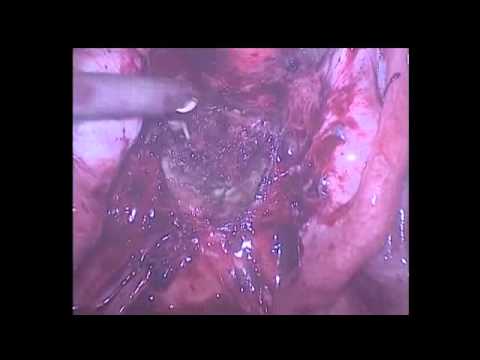Resection of rectovaginal endometriosis done by Dr Nikita Trehan at Sunrise Hospital, New Delhi