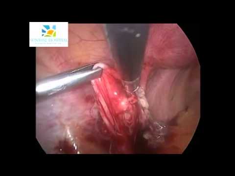 Salpingscopy by Dr Nikita Trehan, Sunrise Hospital Delhi