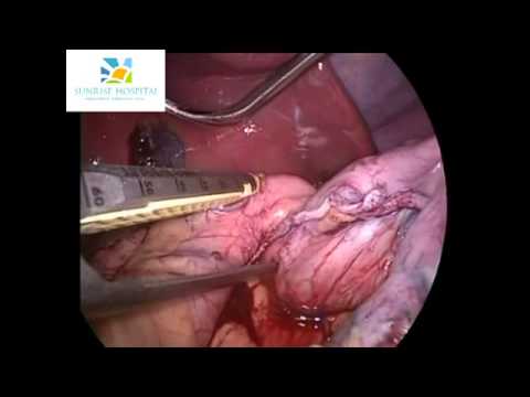 Laparoscopic Sleeve Gastrectomy Bariatric Surgery at Sunrise Hospital