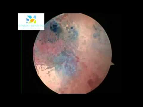 Tubal Cannulation by Dr Nikita Trehan, Sunrise Hospital Delhi