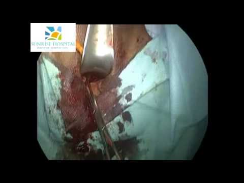 vaginoplasty by Dr Hafeez Rahman & Dr Nikita Trehan in Sunrise Hospital Delhi