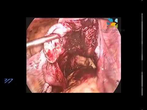 Ovarian Cystectomy by Dr Nikita Trehan