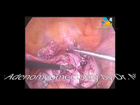 Triple Flap Adenomyomectomy by Dr Nikita Trehan