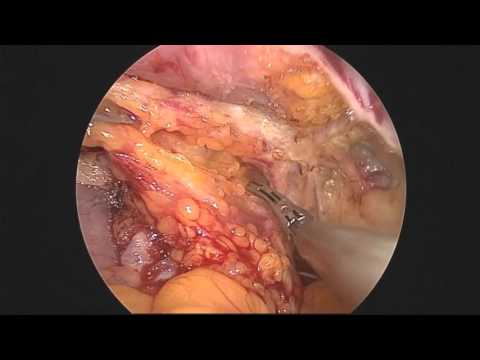 Laparoscopic Sling by Dr. Nikita Trehan