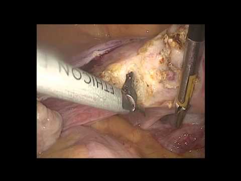 TLH ( Total Laparoscopic Hysterectomy) by Sunrise Method
