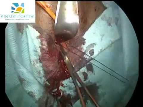 Dr.Nikita Trehan & Dr.Hafeez Rahman -Vaginoplasty