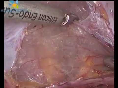 Cervical fibroid vasopressin, Surgery done by Dr.Nikita Trehan in Sunrise Hospital New Delhi