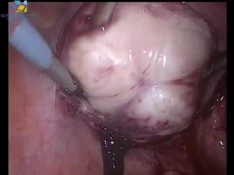 Broad Ligament Fibroid