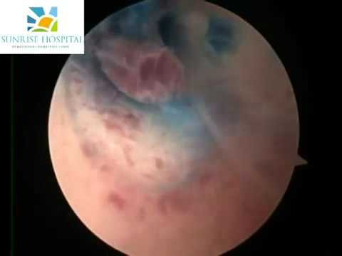 Dr.Nikita Trehan-Tubal Cannulation