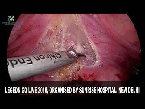 Laparoscopic Unification of Bicornuate Uterus