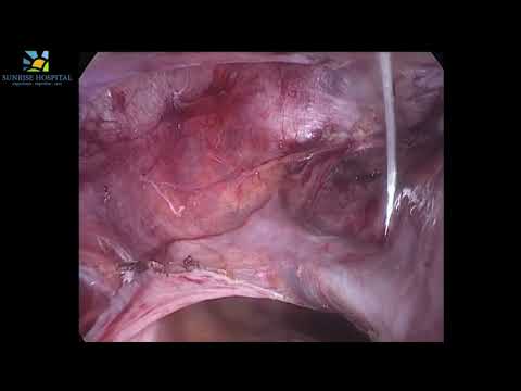 Laparoscopic Cervical Encerclage At 24 Weeks Pregnancy